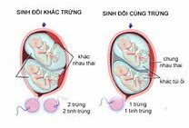 Sinh Đôi Trai Gái Cùng Trứng